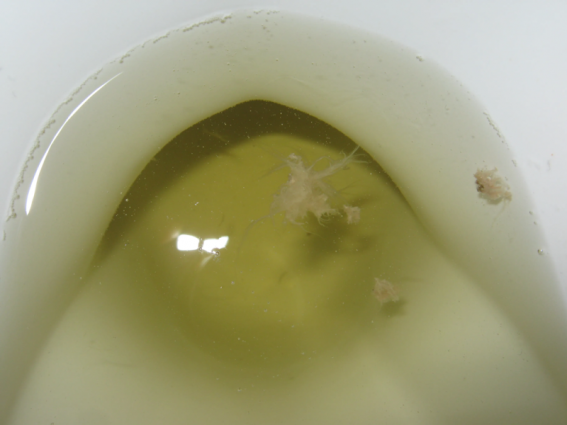 fungus in urine.png