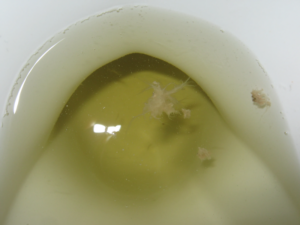 fungus in urine.png